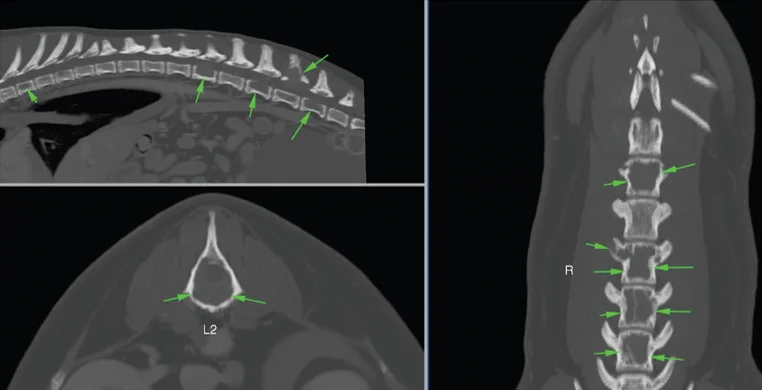 bone cancer case study