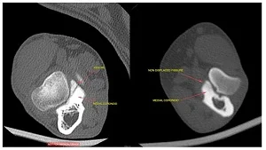 elbow dysplasia in dogs