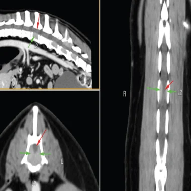 bone cancer case study