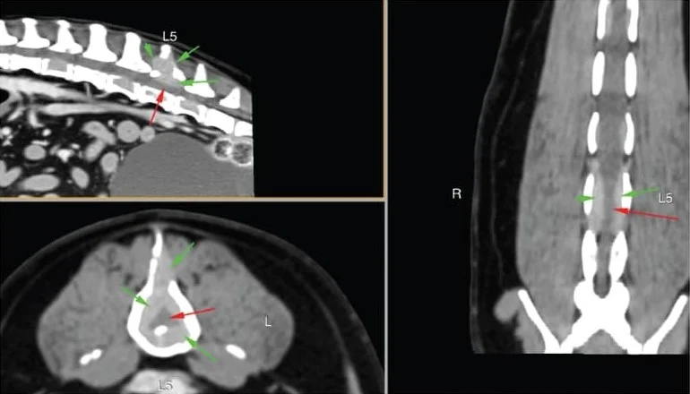 bone cancer case study