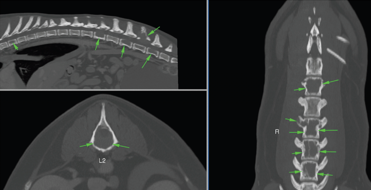 bone cancer case study