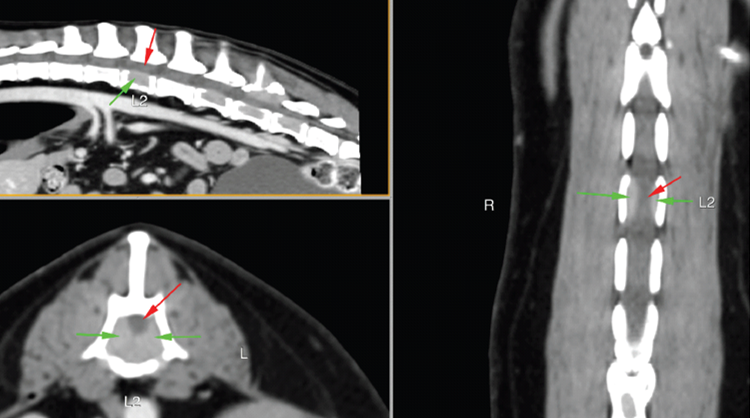 Spinal Cord Compression Xray