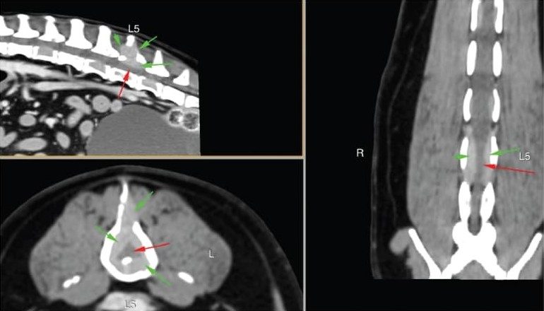 Sagittal, transverse and dorsal MPR MIP images showing contrast-enhancing soft tissue masses at the sites of the osteolysis